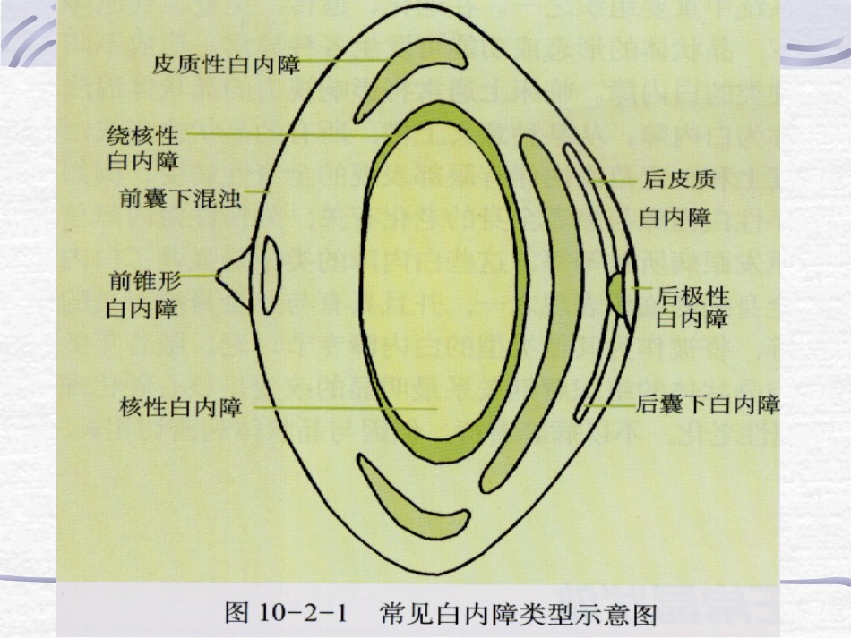 白内障青光眼护理_第3页