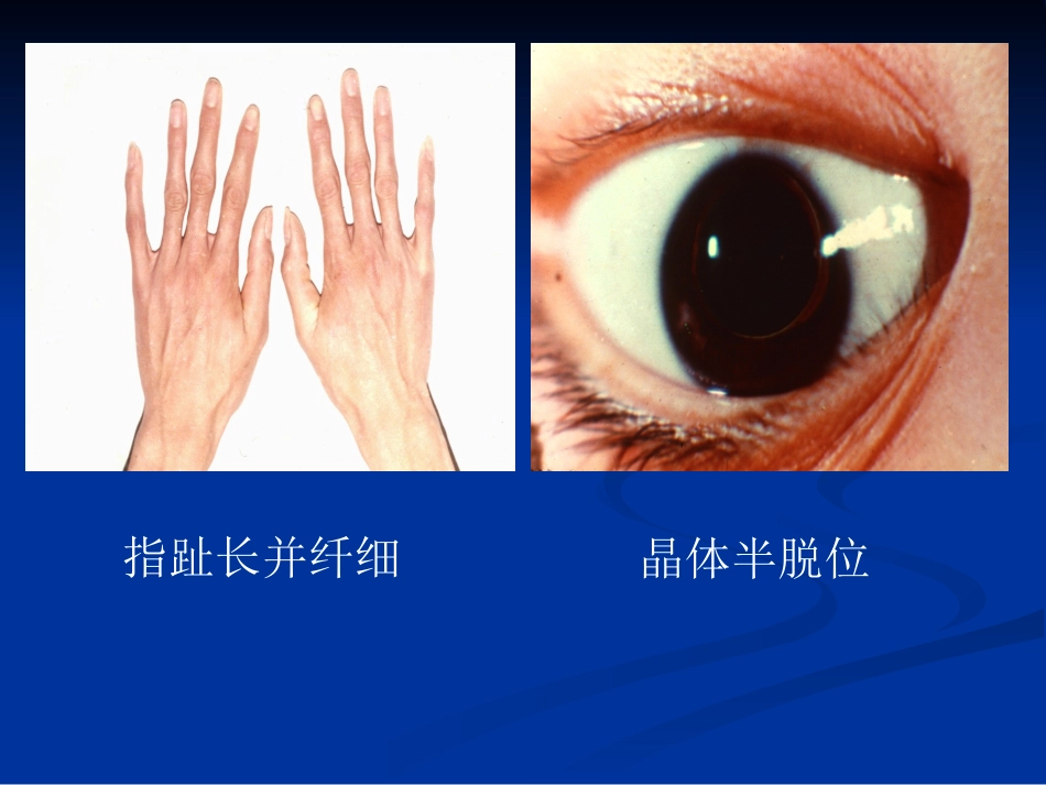 白内障的分类诊断与治疗原则_第15页
