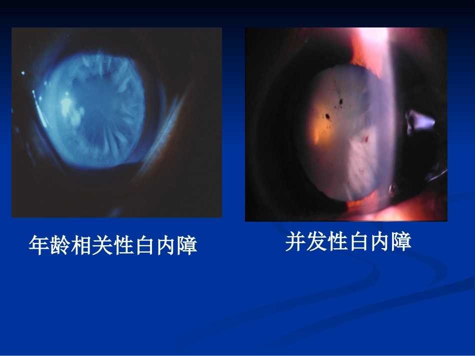白内障的分类诊断与治疗原则_第5页
