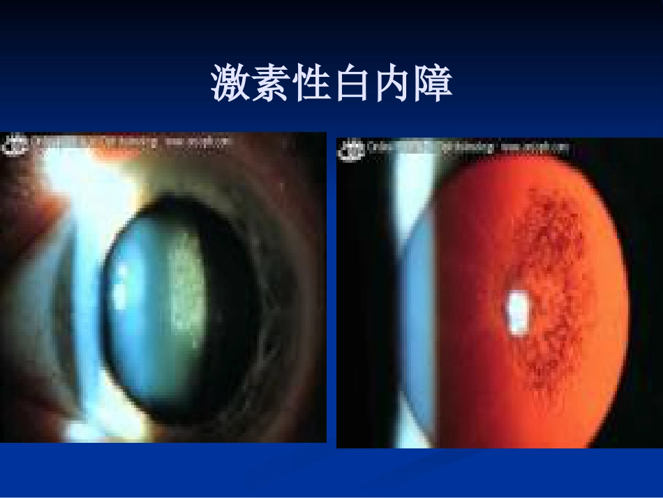 白内障的分类诊断与治疗原则_第6页