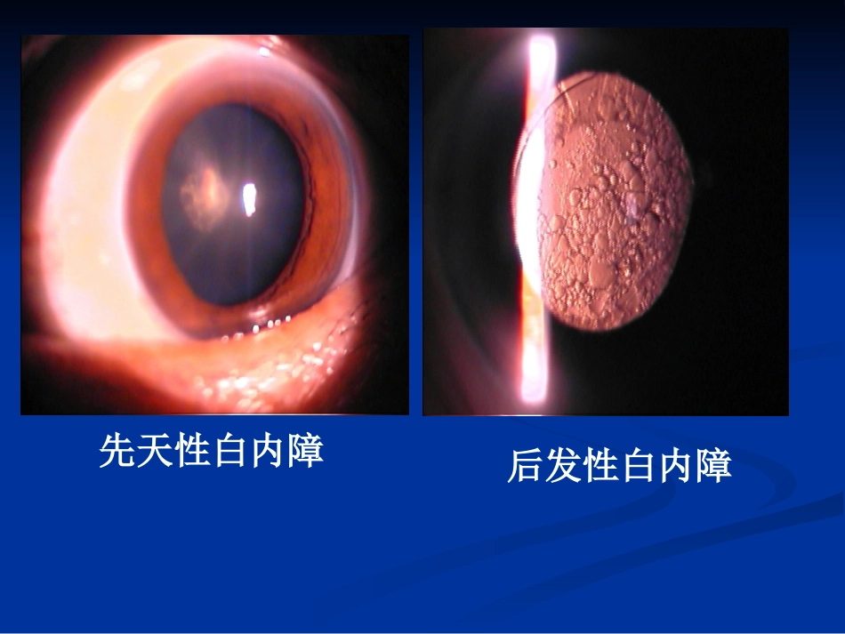 白内障的分类诊断与治疗原则_第7页