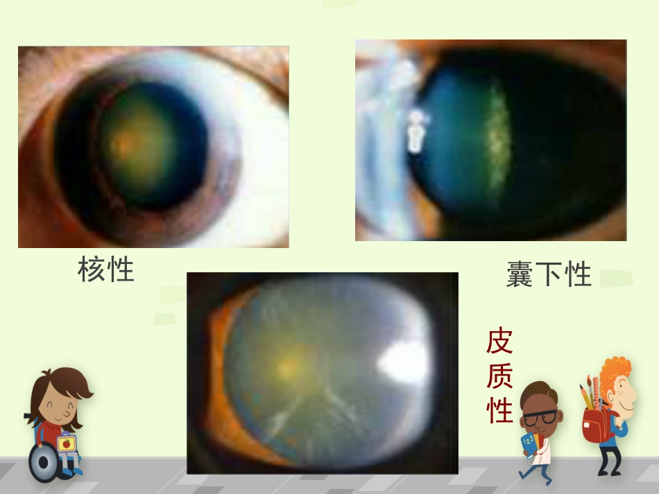 白内障 讲课_第15页