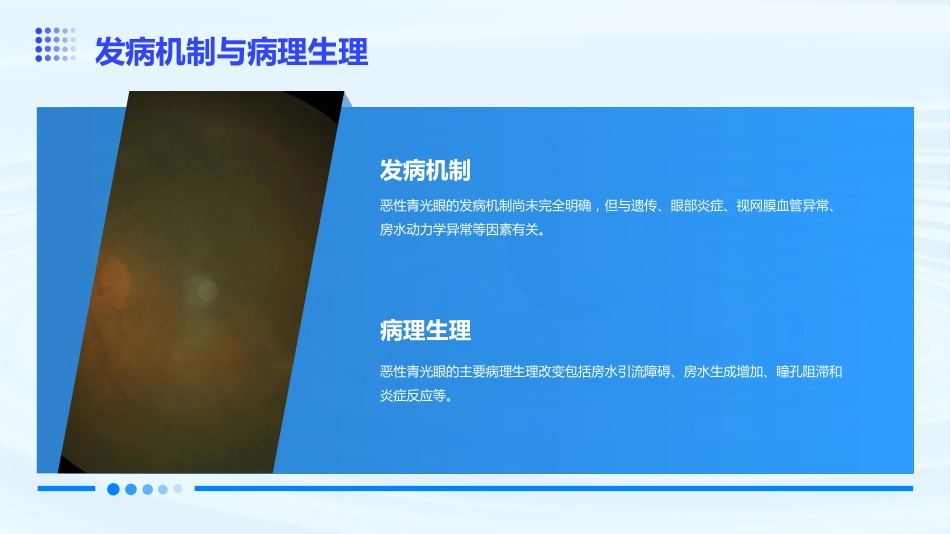 恶性青光眼医学课件_第5页