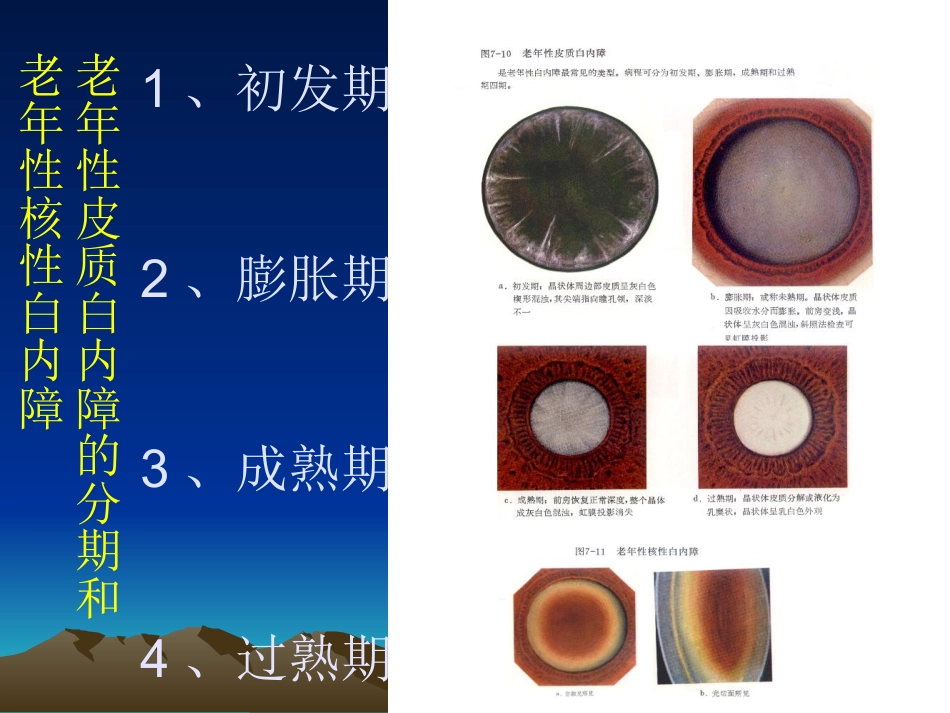 白内障课件_第10页