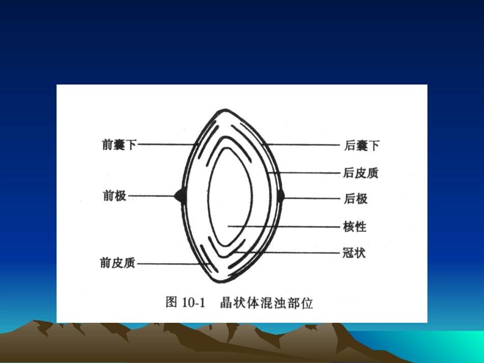 白内障课件_第4页