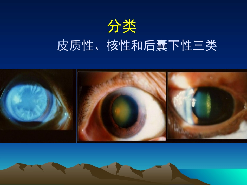 白内障课件_第9页