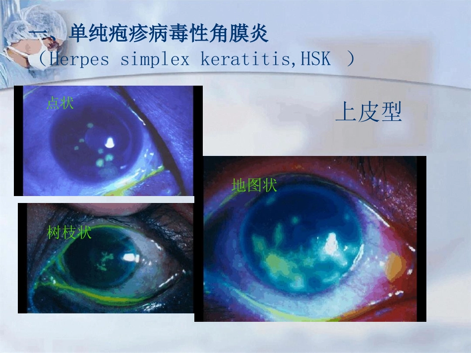 病毒性角膜炎课件_第11页