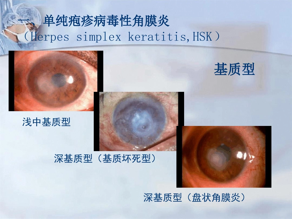 病毒性角膜炎课件_第12页