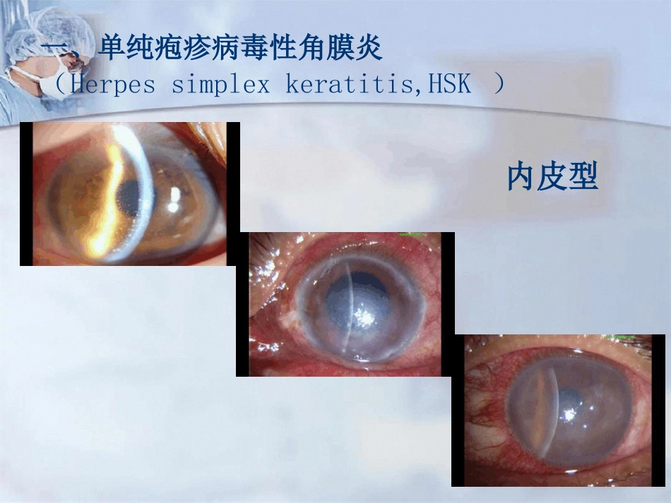病毒性角膜炎课件_第13页