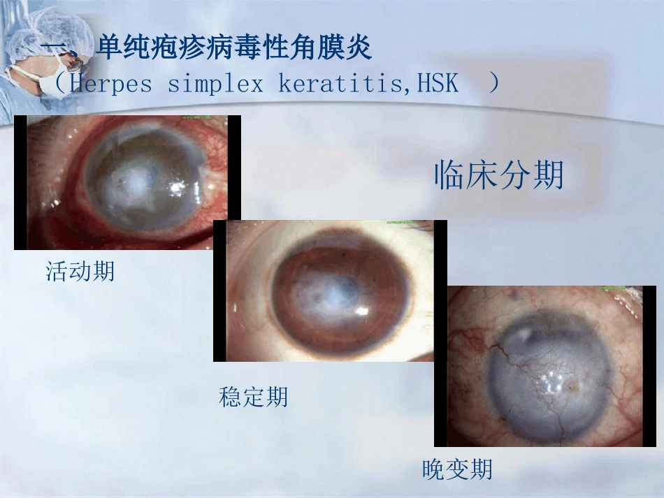 病毒性角膜炎课件_第14页