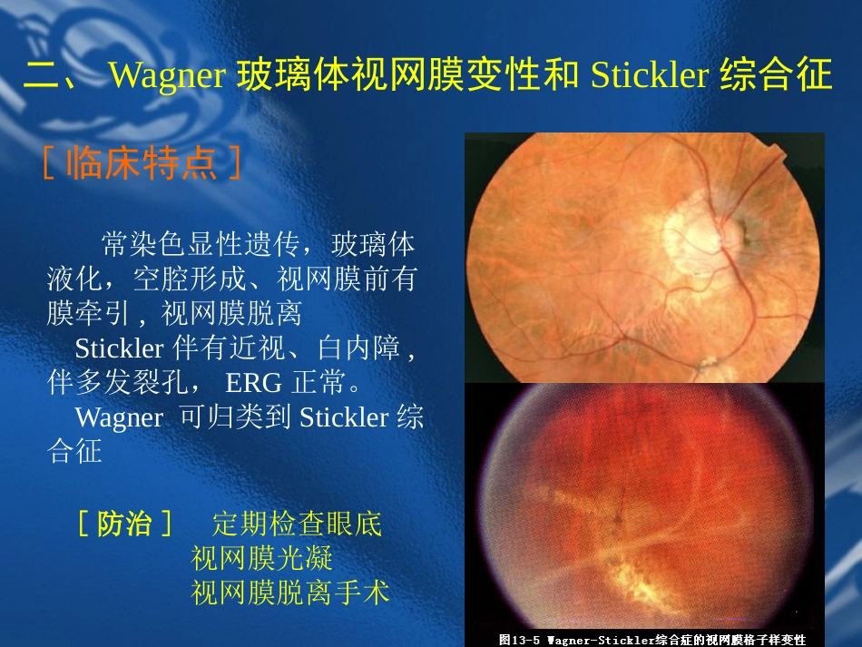 玻璃体疾病 PPT_第10页