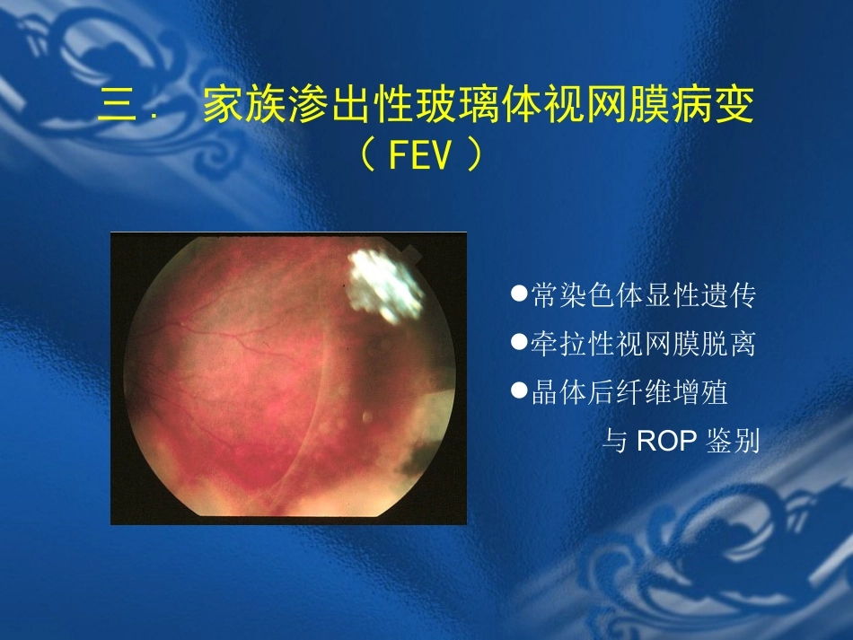 玻璃体疾病 PPT_第11页