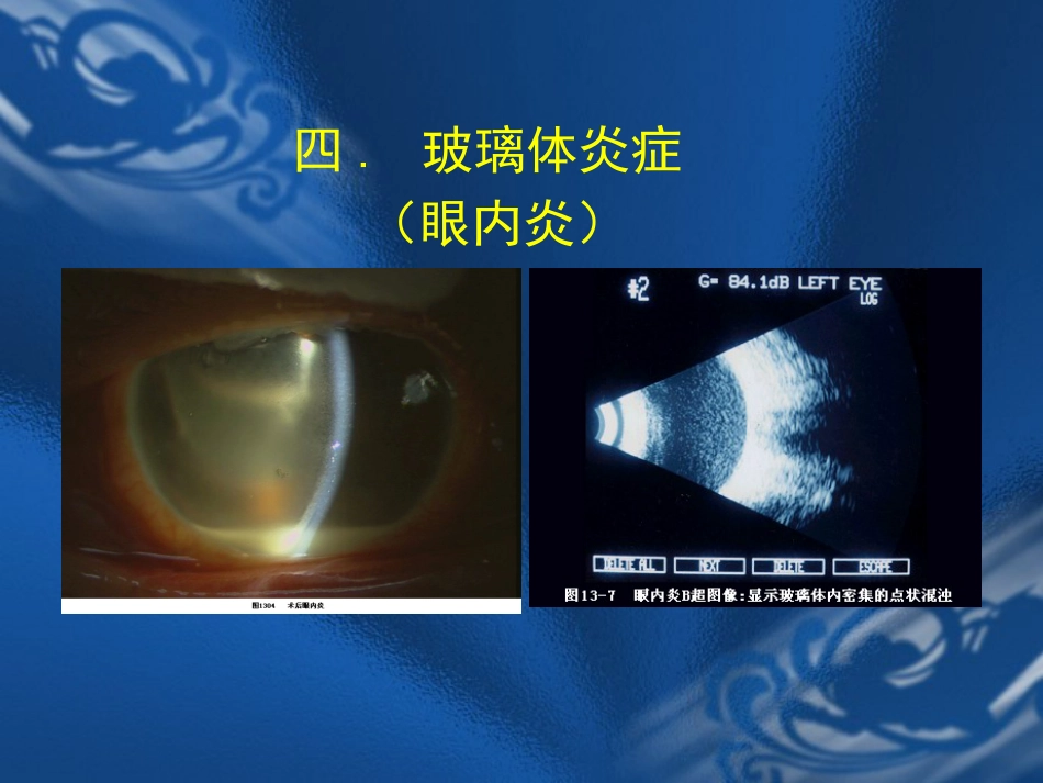 玻璃体疾病 PPT_第12页