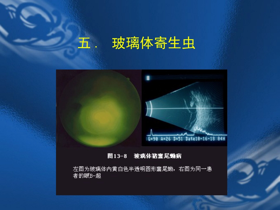 玻璃体疾病 PPT_第13页