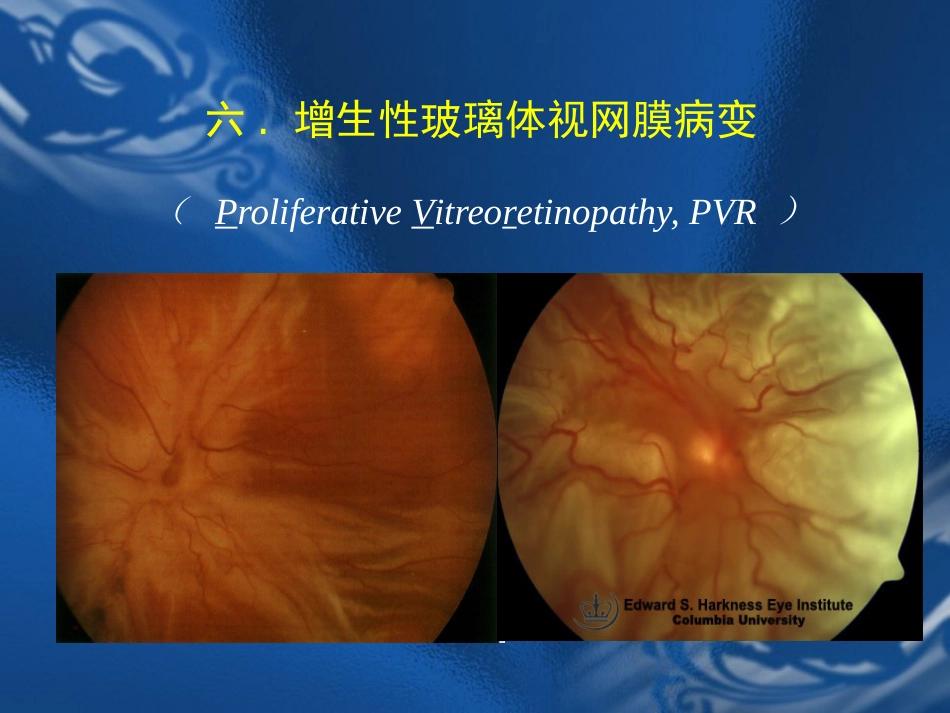 玻璃体疾病 PPT_第14页