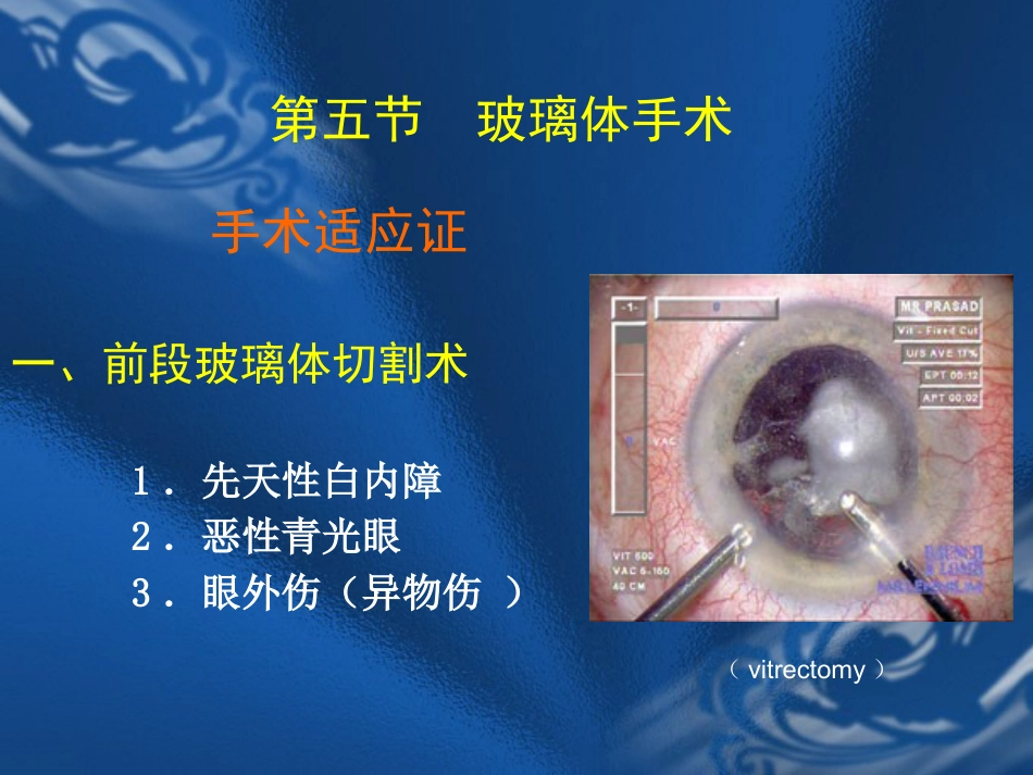 玻璃体疾病 PPT_第15页