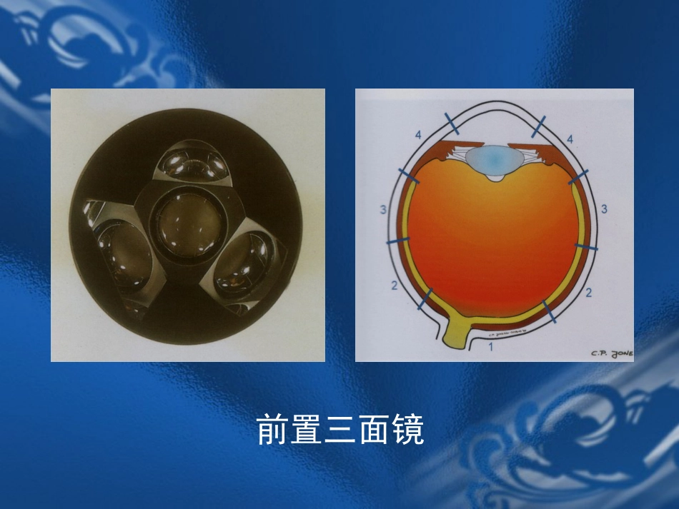 玻璃体疾病 PPT_第4页