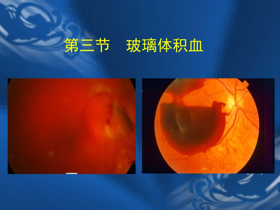玻璃体疾病 PPT_第7页