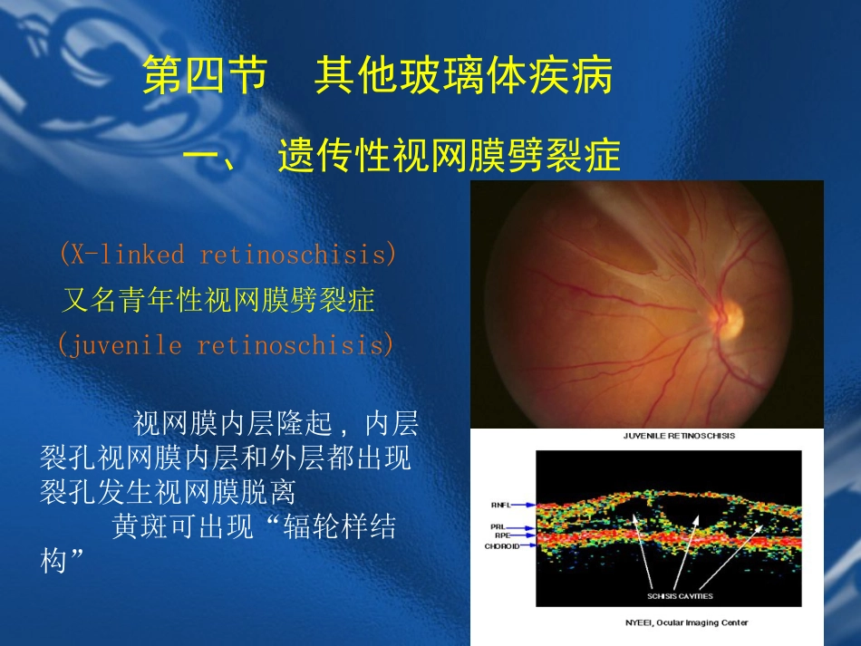 玻璃体疾病 PPT_第9页