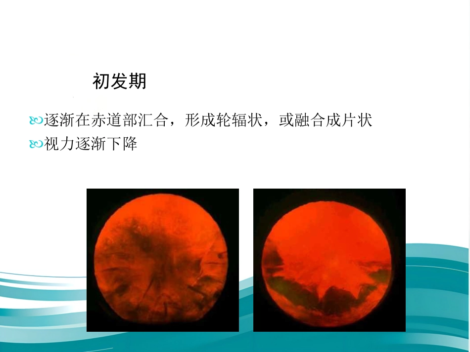 白内障和IOL计算 _第10页
