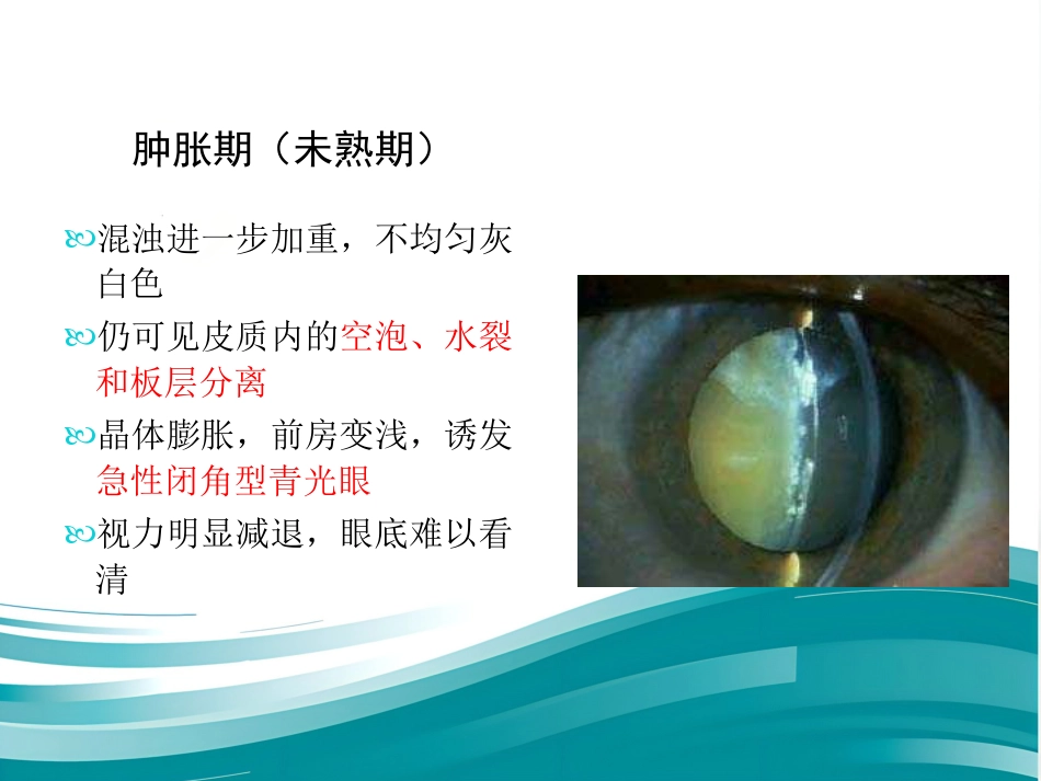 白内障和IOL计算 _第11页