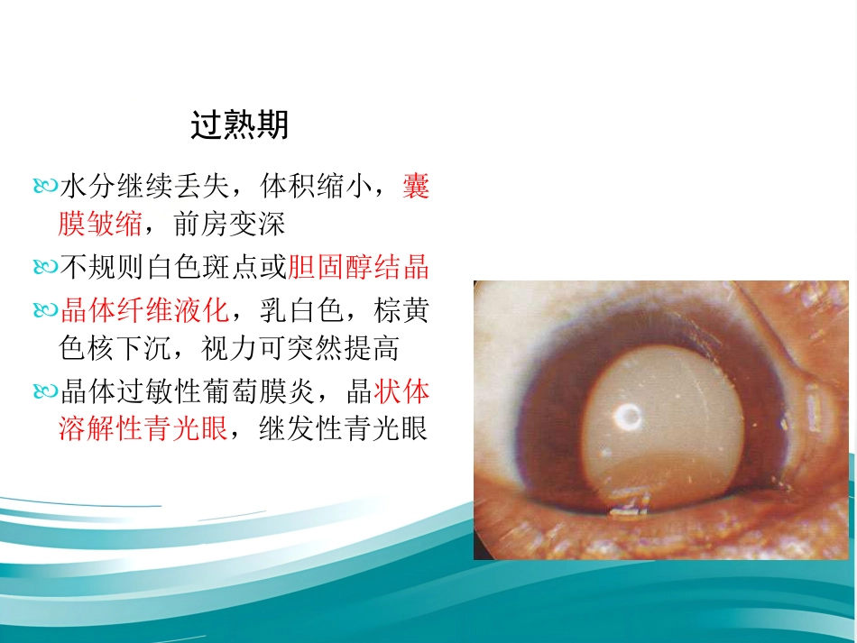 白内障和IOL计算 _第13页