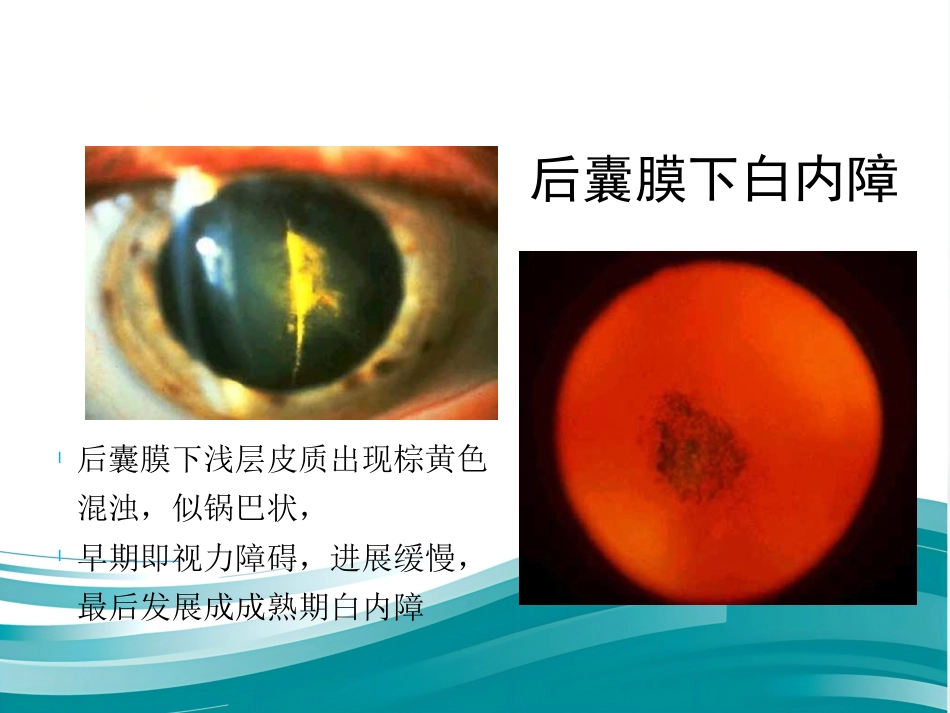 白内障和IOL计算 _第14页