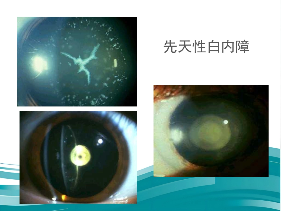 白内障和IOL计算 _第15页