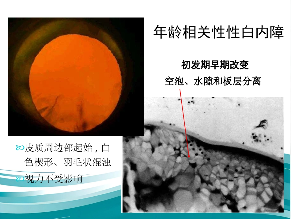 白内障和IOL计算 _第9页