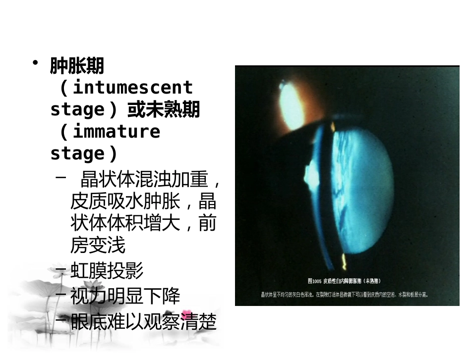 白内障讲座_第10页