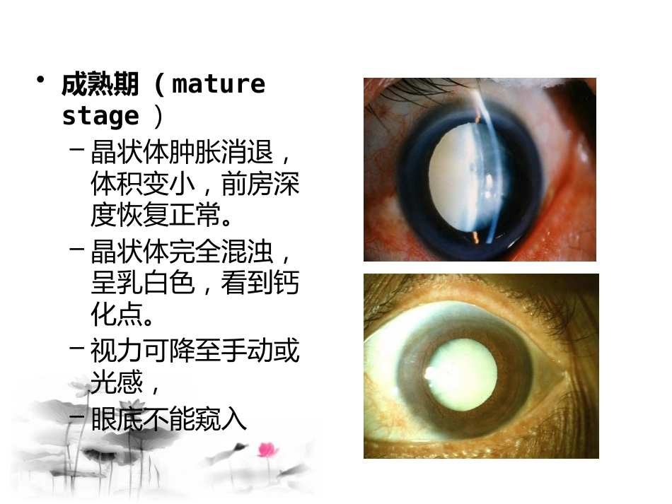 白内障讲座_第11页