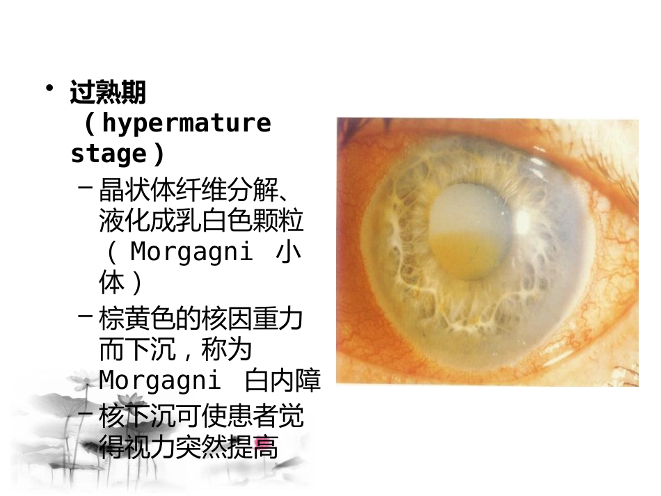 白内障讲座_第12页