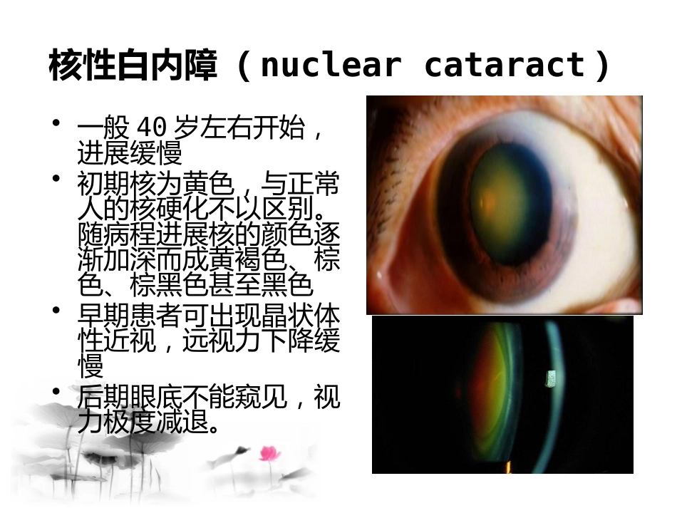 白内障讲座_第13页