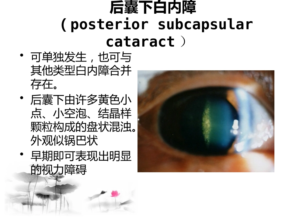 白内障讲座_第14页