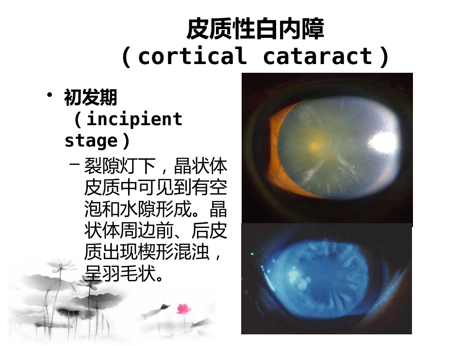 白内障讲座_第9页