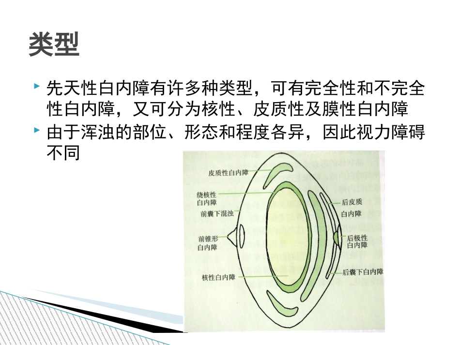 《先天性白内障》_第3页