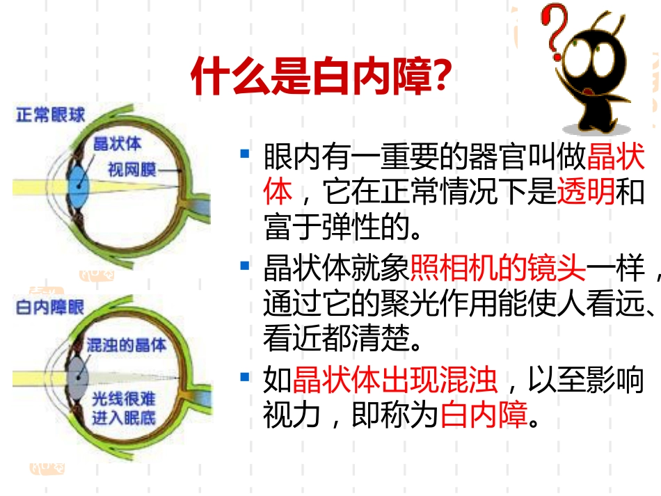 白内障科普讲座 _第3页