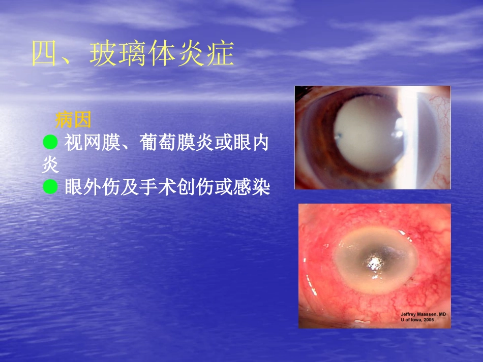 玻璃体疾病_第12页