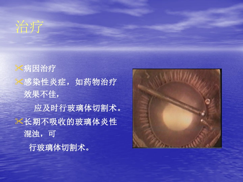 玻璃体疾病_第14页