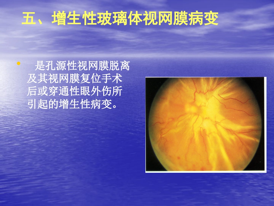 玻璃体疾病_第15页