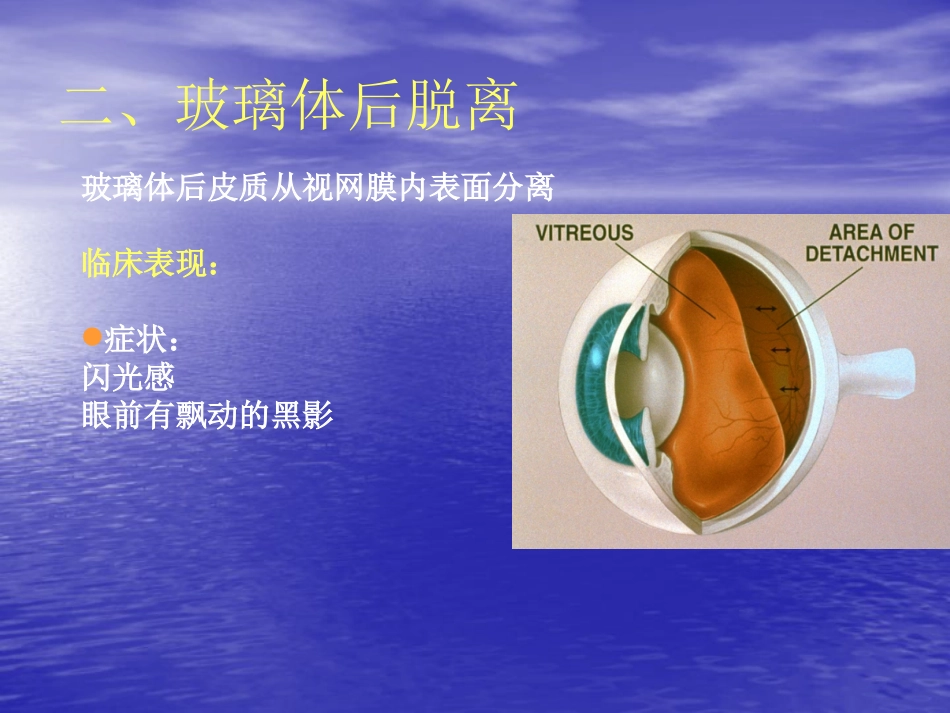 玻璃体疾病_第4页