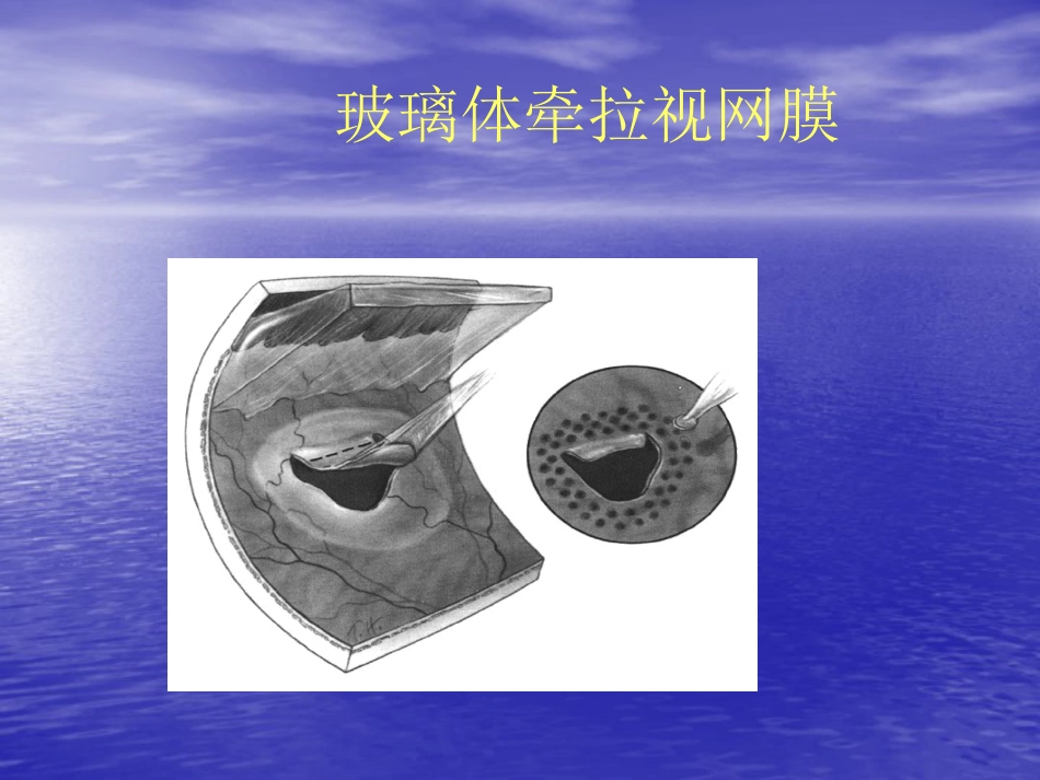 玻璃体疾病_第6页