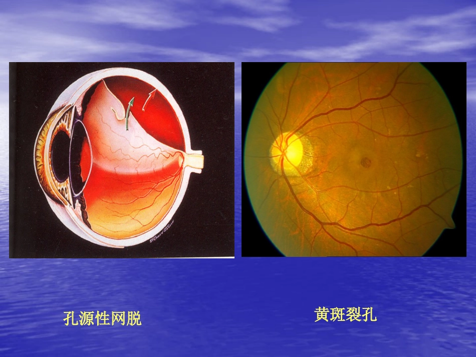 玻璃体疾病_第7页