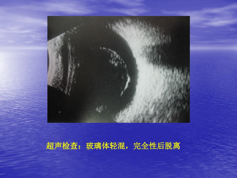玻璃体疾病_第8页