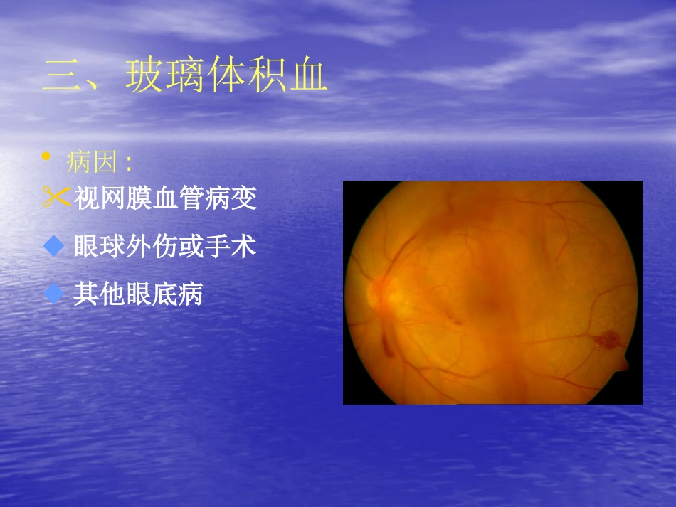 玻璃体疾病_第9页