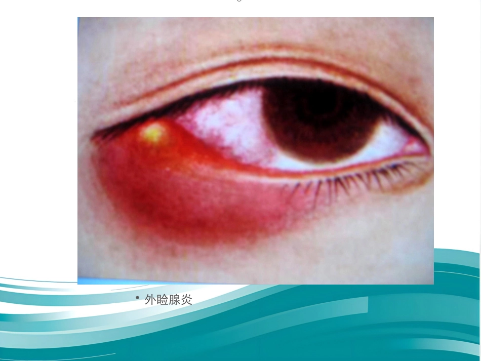 《眼科学眼睑病》_第13页