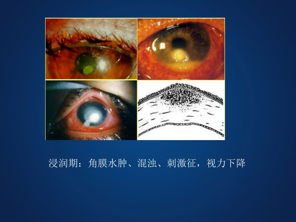 《眼科学》眼表疾病、角膜病_第14页