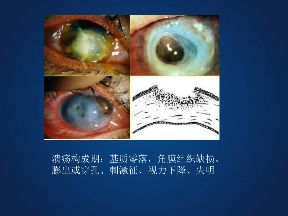 《眼科学》眼表疾病、角膜病_第15页