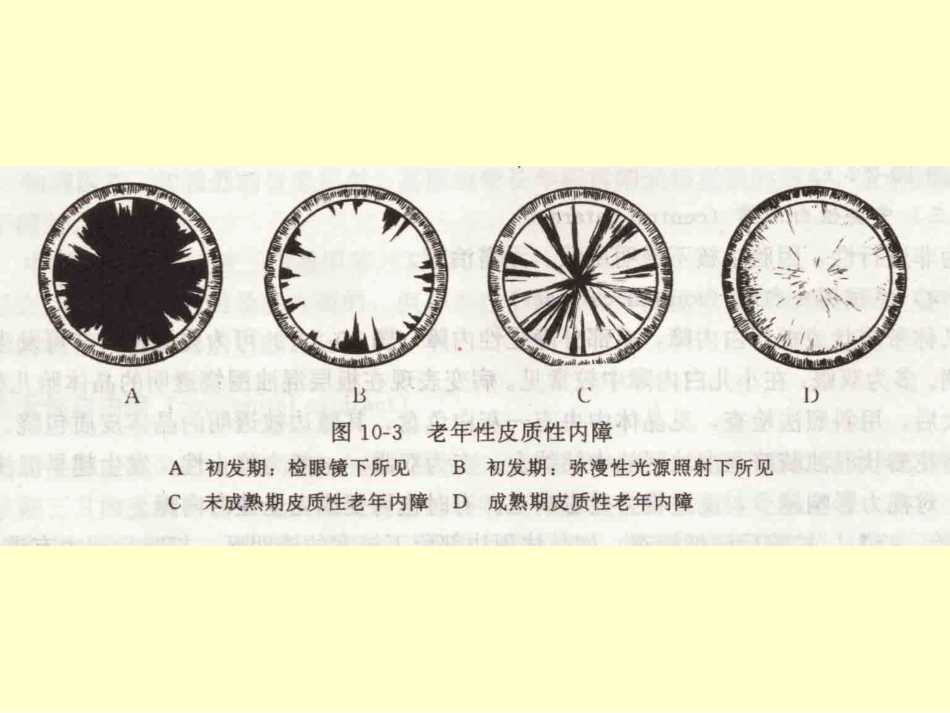 白内障晶体PPT医学课件_第14页