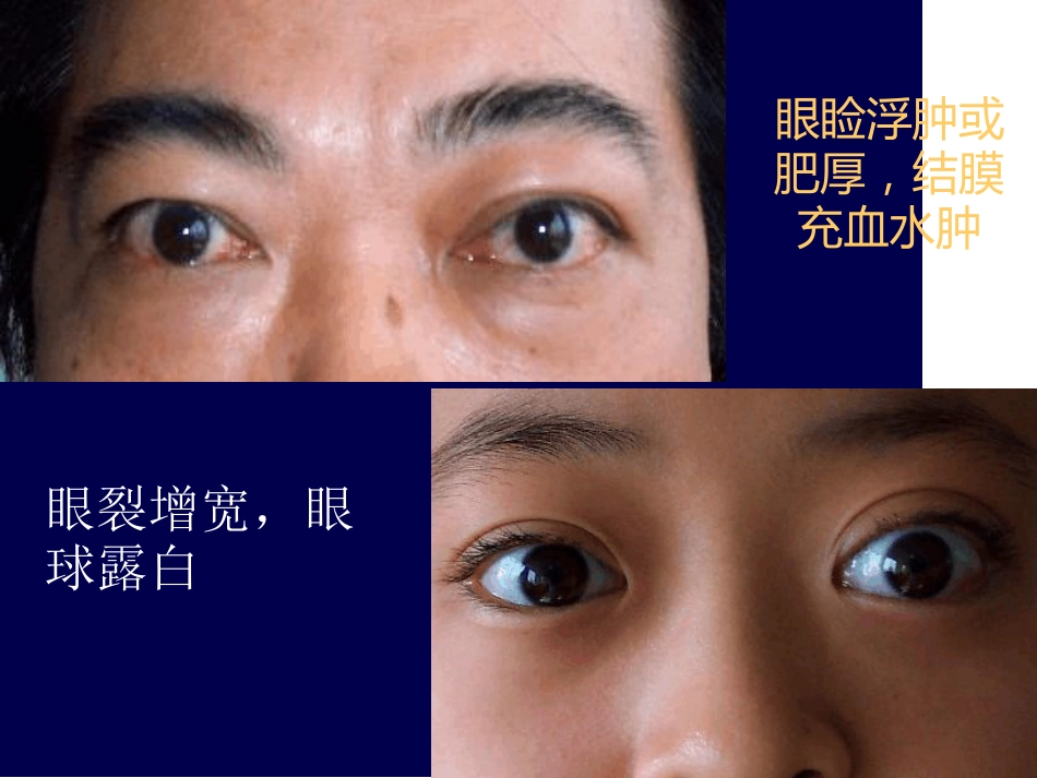 Graves眼病诊治新进展最新_第11页